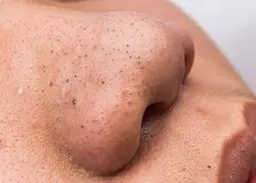 【本日限定‼️黒ずみ/毛穴詰まり】鼻　毛穴洗浄トルネード洗浄