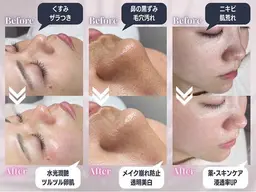 【ハイドラフェイシャル】毛穴の黒ずみや開きのお悩みを解消✨