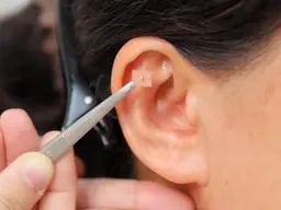 耳つぼダイエットカウンセリング+施術１回分