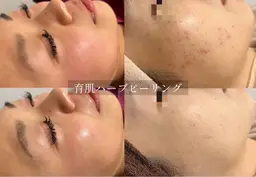 痛み剥離なし☆育肌®︎ハーブピーリング/肌荒れ・乾燥・毛穴・ニキビ・小ジワ・赤み・むくみ等を自らの力で肌質改善！