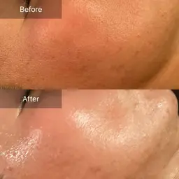 針、メスなし❤️毛穴修復スペシャル⭐️生コラーゲン注入付き【大きい毛穴、たるみ凸凹毛穴ケア】お茶カウンセリング込120分