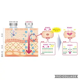 ニキビ、くすみでお悩みの方❗️乳酸ピーリング➕「VC20導入」エレクトロポレーション美白コース✨