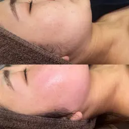 フェイシャルワックス脱毛