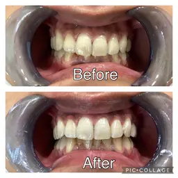 🦷✨体験セルフホワイトニング💎