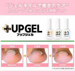 巻き爪ケア　UPジェル　足指1本