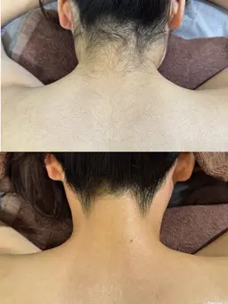 ミニモ学割🍓背中上＋うなじ＋もみあげワックス脱毛【横顔美人/オフショル/成人式前撮り/アップヘア】