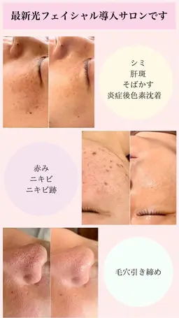 光エステでシミ取り肌質改善！