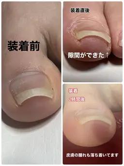 巻き爪解放＊レジスタンスプレート両親指