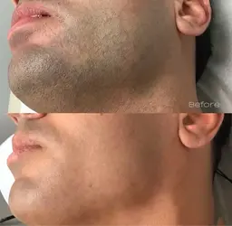 【平日9時半~16時予約限定】ひげ脱毛:4400円→3500円