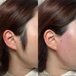 【もみあげワックス脱毛】挙式/前撮り/デート前に◎