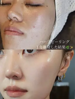 ご新規様限定☘️透明感UP🌿剥離なしハーブピーリング」