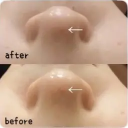 小顔＆整体コルギ＆ハーブピーリング✨80分