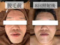 🚹【メンズ全顔脱毛】1回のみの使用可能です☘️お顔のトーンアップ、毛穴開きの改善、肌荒れ防止にも繋がります🌟