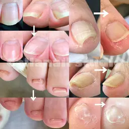 不快感スッキリ単発【巻爪カット】