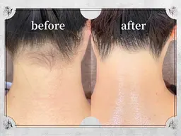 期間限定!【男女OK】うなじ脱毛/¥1500☆★30分