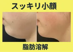 【卒業・入学前に憧れの小顔へ】脂肪細胞を減らす話題の施術|ダウンタイムなし！理想の小顔をゲット！