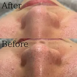 毛穴洗浄 鼻のみ ✩ 彡 ⋆꙳