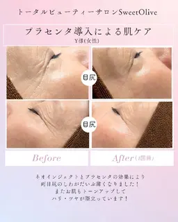 【メンズもOK】プラセンタフェイシャル（高速エアジェット）30分