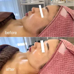 【ツヤ肌・潤い肌】大人気ララピール+エレクトロポレーション美容液導入SET