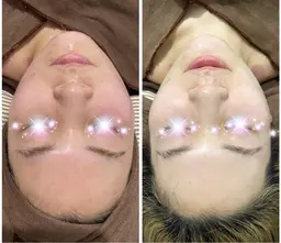 ハーブピーリング(剥離なし)