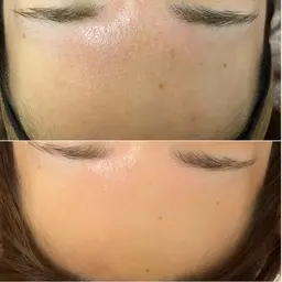 痛くないリジュラン2.5cc✨