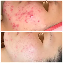 ミニモ限定🌱医療提携サロン【🌿ハーブピーリング】最強の肌質を‼️選べる半顔のハーブ