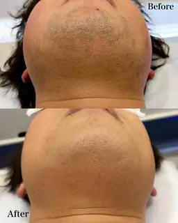 ヒゲ脱毛(男性限定)男性脱毛No.1✨顔全体施術いたします♪2回目からも同価格なのでご安心ください✨