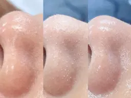 【毛穴洗浄】ハイドロディープクレンジング/小鼻の黒ずみ集中ケア