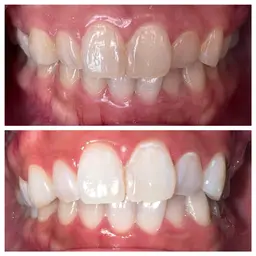 【短期間で白くしたい方♪】セルフホワイトニング15分✖︎3回セット