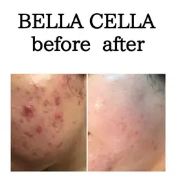 韓国クリニック美容「ベラセーラ」肌質改善を望む方はこちら。ニキビで悩む時間はもう要らない