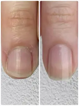 8回施術💅自爪育成モニター
