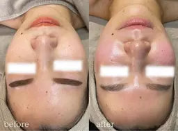 毛穴レス/艶肌/お悩み別クリスティーナトリートメント