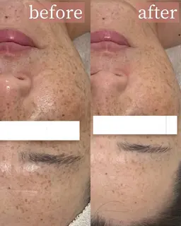 【ツヤ肌ピーリング】ラミネーションピール×ハイドロジェリーマスク