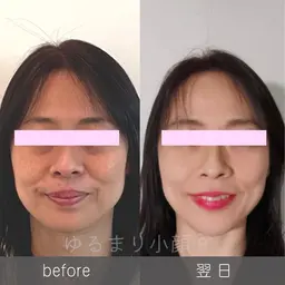 一番人気《たるみ卒業 》Vライン小顔へ！　優しいタッチの【頭蓋骨マッサージ×小顔フェイシャル】65分⭐︎半額の6500円