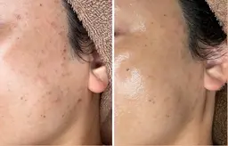 ダウンタイムなし肌質改善❣️バクテリウムピーリング🌿