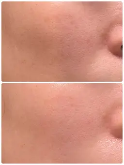 【皮膚の緩み｜張り｜たるみ】リフトアップフェイシャル