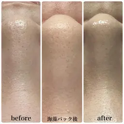 【平日限定/この春褒められる肌作り】全顔３D毛穴洗浄＋顔無VIO込全身脱毛¥11,500