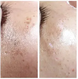 【リピーター様】🍀韓国肌管理【ララピール】お試し体験40分お顔&首➕鎮静マスク/ニキビ肌、水光肌、敏感肌❄️