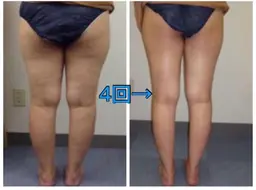 ❤️✨minimo新規限定✨❤️【美脚集中】キャビ★太もも、脚首が気になる方へ!30分体験3980円