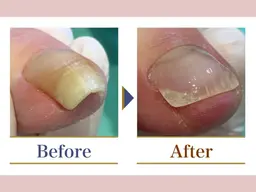 巻き爪補正【1箇所】+初回 爪切りサービス付き