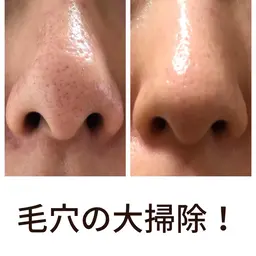 【毛穴で悩んだらこれ!】毛穴すっきりスタンダードコース