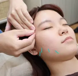 【平日限定✨】お顔の悩みならぜったいコレ‼️《美容鍼灸+カウンセリング 60分コース》