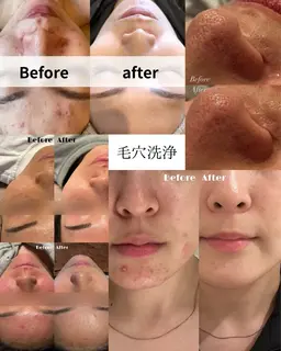 【韓国水光肌】美容液洗浄&つるん肌実感◎すっぴん美肌へ✨毛穴すっきり洗浄体験〈90分〉¥0