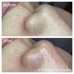 ⭐️お試し価格⭐️即効果実感❣️【頑固な黒ずみ・角質角栓に】浮かせる毛穴洗浄3パーツ(鼻・顎・眉間)フェイシャル45分