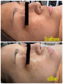 【美白透明肌】REVI  白玉ハーブピーリング