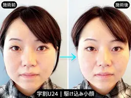 【学割U24】むくみスッキリ小顔｜美容鍼 25分（メイクOK）