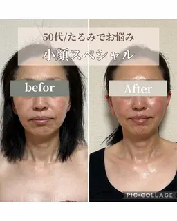 【モニター3名様募集】エイジングケア付小顔3回数券