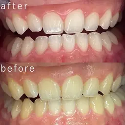 【しっかり白くさせるなら🦷✨】縛りナシ回数制限なし!🉐白さ実感×コスパ最強✨ホワイトニングのみの無制限コース😉✌️