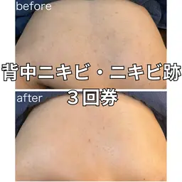 🌿背中ハーブピーリング3回集中コース🌿\ドレス姿に自信を✨ブライダルやイベント前の駆け込みケアに/