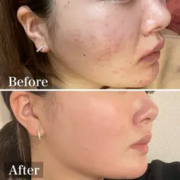 【ニキビ・毛穴・赤み・くすみ】光フェイシャル体験(18歳​〜​29歳限定)